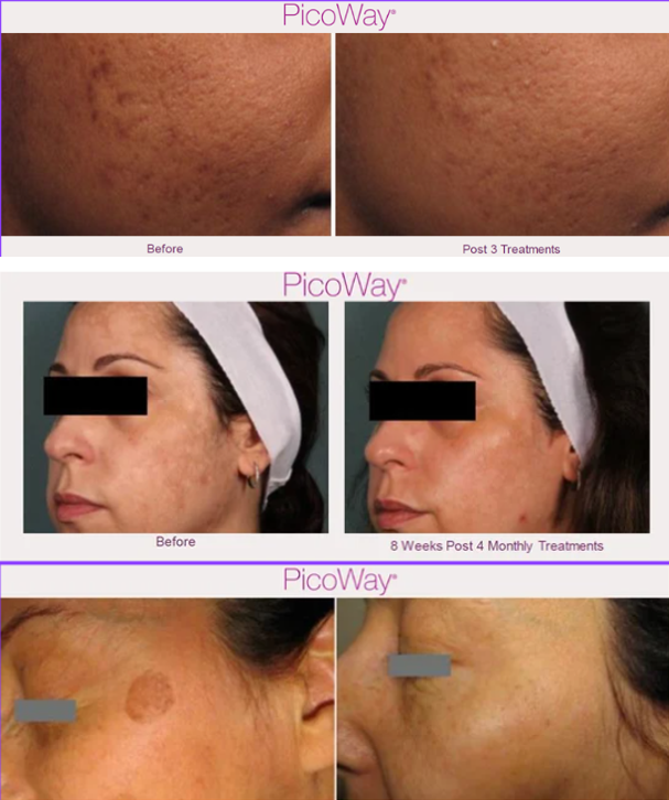 PicoWay Laser Johor Bahru (JB) Testimonial | Lyvin Clinic JB